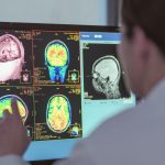 Apel în sprijinul pacienților cu neurofibromatoză de tip 1: diagnostic fără întârzieri, tratament fără întreruperi!