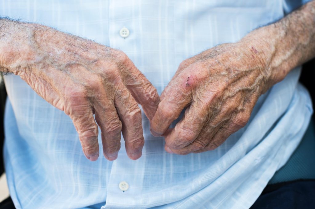 Un bătrân de 92 de ani a ajuns la spital cu arsuri după ce a verificat butelia cu chibritul