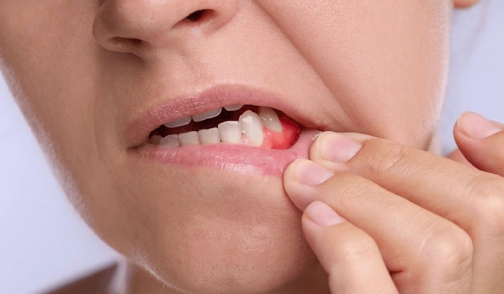 Sângerarea gingiilor: semn banal sau primul indiciu al unei probleme parodontale?
