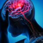 Medicul neurolog Răzvan Radu: Tratăm AVC-ul acut ischemic cam în primele şase ore / Şi în jurul Bucureştiului există un număr de spitale judeţene care nu au capacitatea să-şi acopere liniile de gardă pe Neurologie, cum cred că nu au nici pe Cardiologie