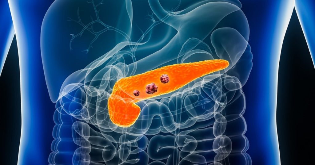 Un medicament experimental a dat rezultate promițătoare în cancerul pancreatic metastatic. Tumorile s-au redus la 9 din 22 de pacienţi
